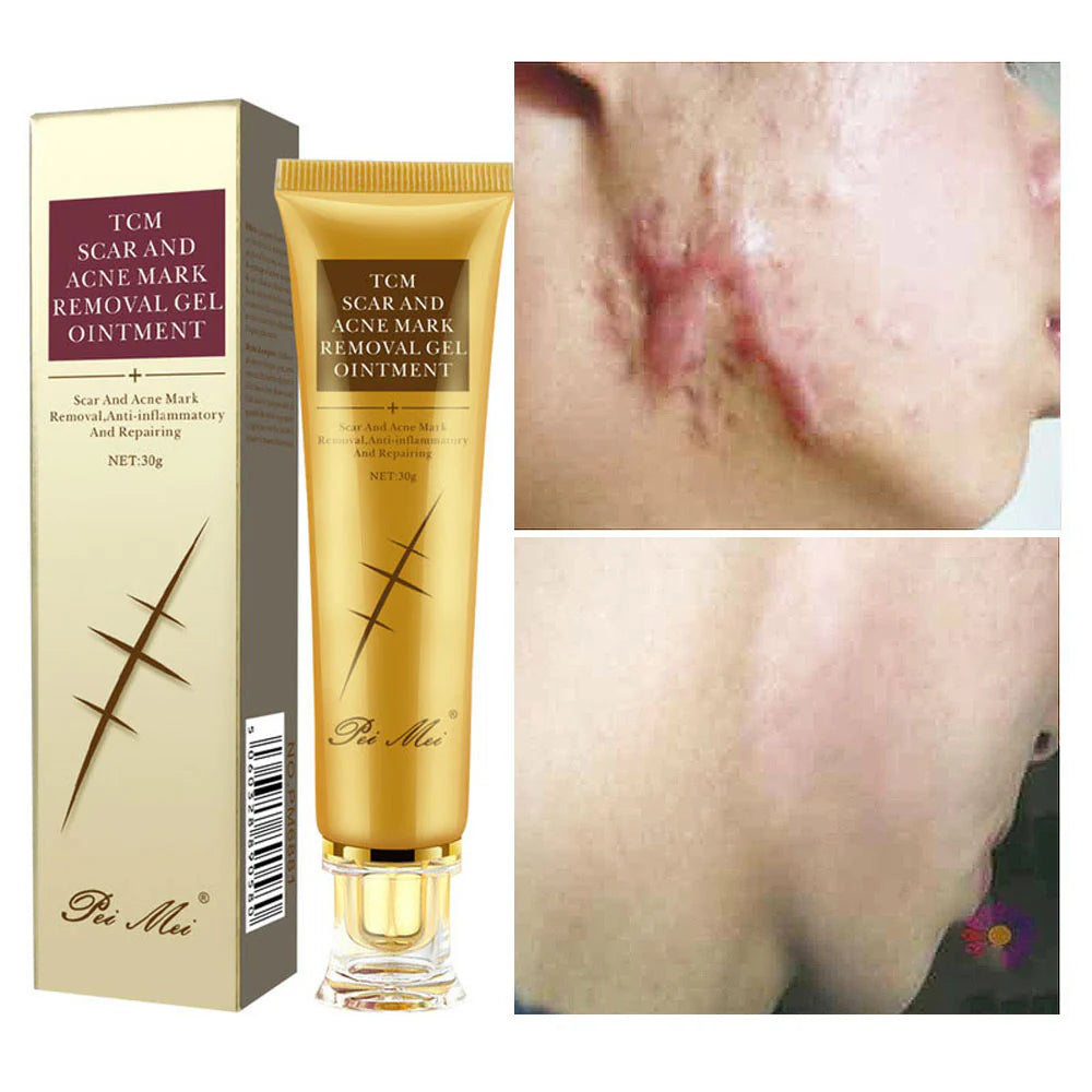 Gel pour l'élimination des cicatrices et des marques d'acné TCM.