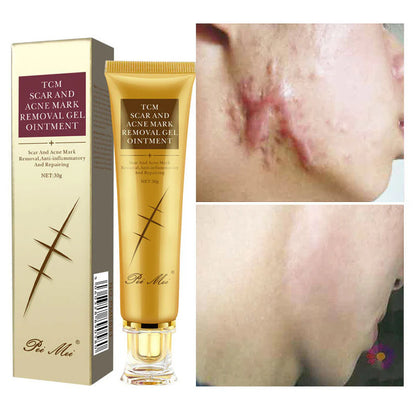 Gel pour l'élimination des cicatrices et des marques d'acné TCM.